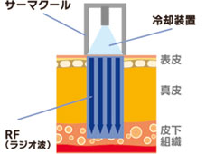 サーマクールの仕組み