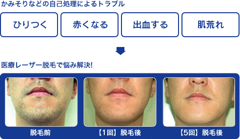 かみそりなどの自己処理によるトラブル　ひりつく　赤くなる　出血する　肌荒れ　→　医療レーザー脱毛で悩み解決！　脱毛前　【1回】脱毛後　【5回】脱毛後