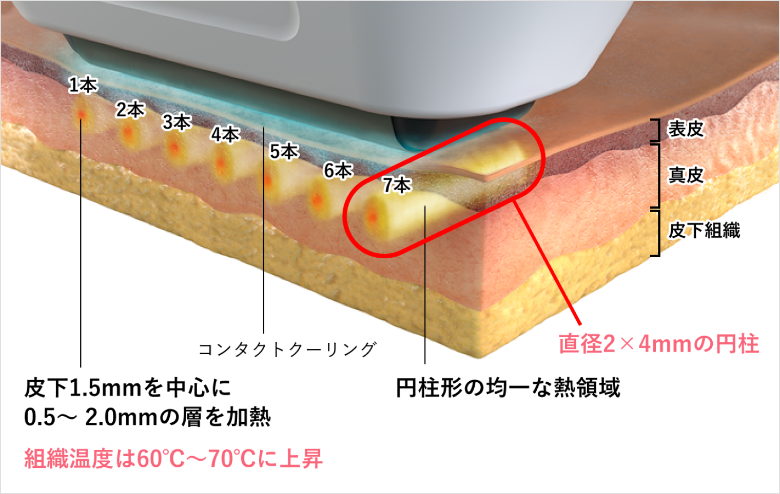 実際の照射イメージ
