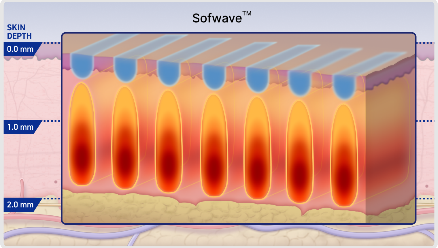 実際の照射イメージ